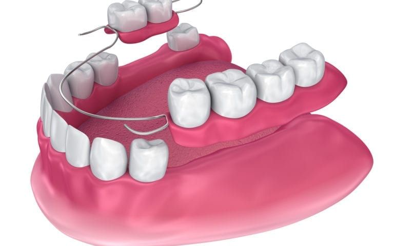 Rendering Of Partial Denture