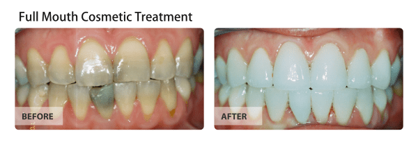 full-mouth-cosmetic-treatment