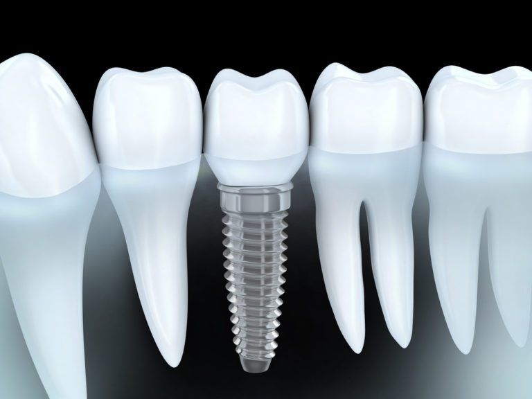 3d rendering of how a dental implant is anchored into the gum/bone