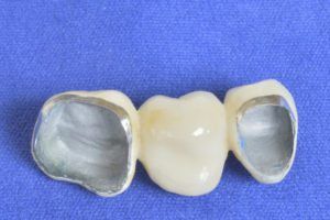 Casting of PFM restorations presented on a blue surface