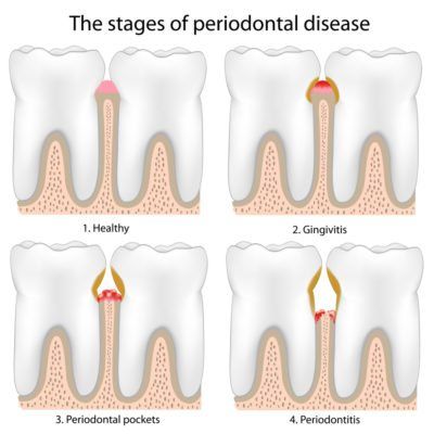 Illustrated Infographic showing 4 stages of Periodontal Disease