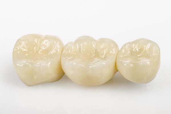 a 3-unit dental bridge