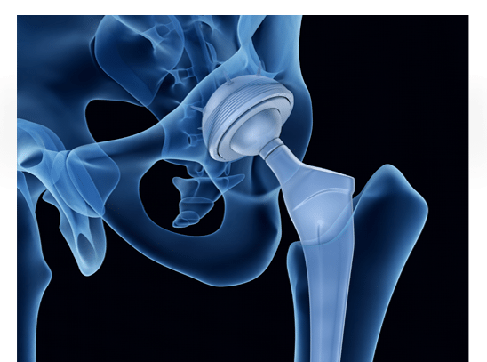 Hip Replacement Surgery, Total Hip Arthroplasty