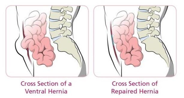 davinci hernia repair