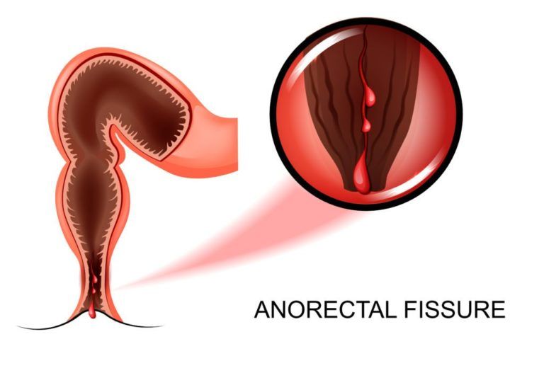 internal anal fissure