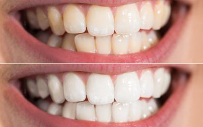 3 Procedures For Whitening Your Teeth
