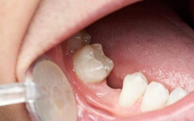 Why Replacing Your Lost Teeth Can Save Your Oral Health!