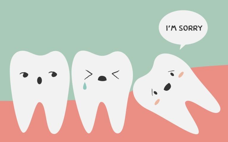 Cartoon of impacted wisdom tooth