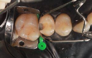 Cavities