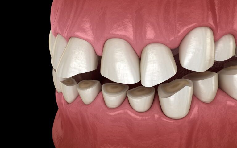 Damaged Teeth