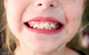 Child with Crooked Teeth