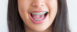 Close up of a girl smiling and showing off her braces
