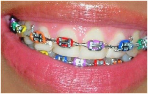 Best Color For Braces - What Color Braces Should I Get?