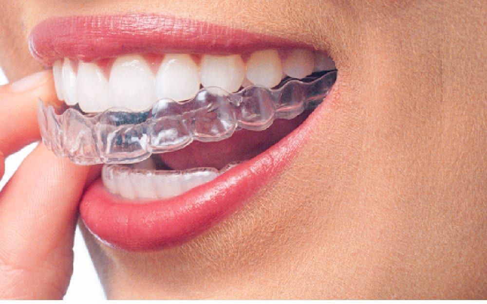 Invisalign-09-1