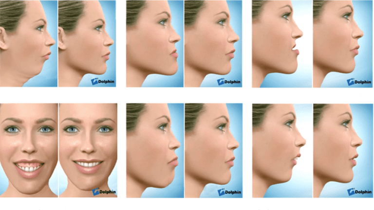 Jaw Surgery Superior Care Orthodontics   Jaw Surgery 768x432 