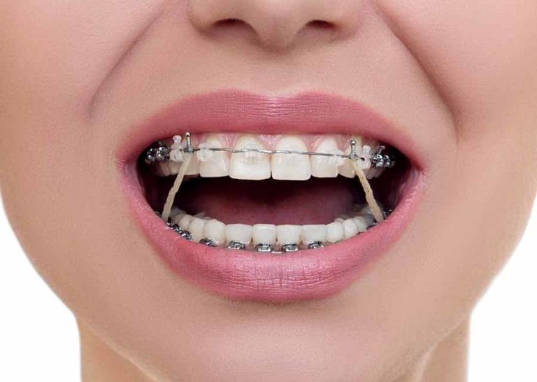 elastics-in-orthodontic-treatment