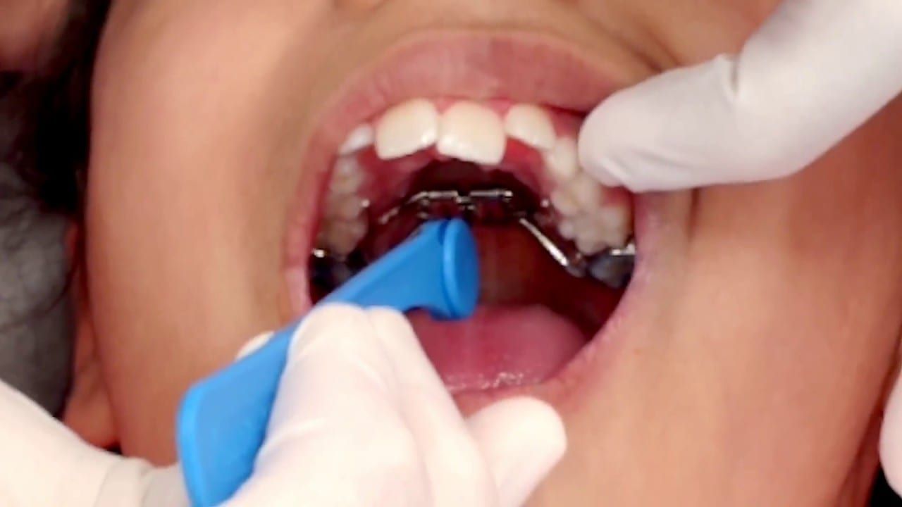 How Do I Care For My Orthodontic Expander? - Superior Care