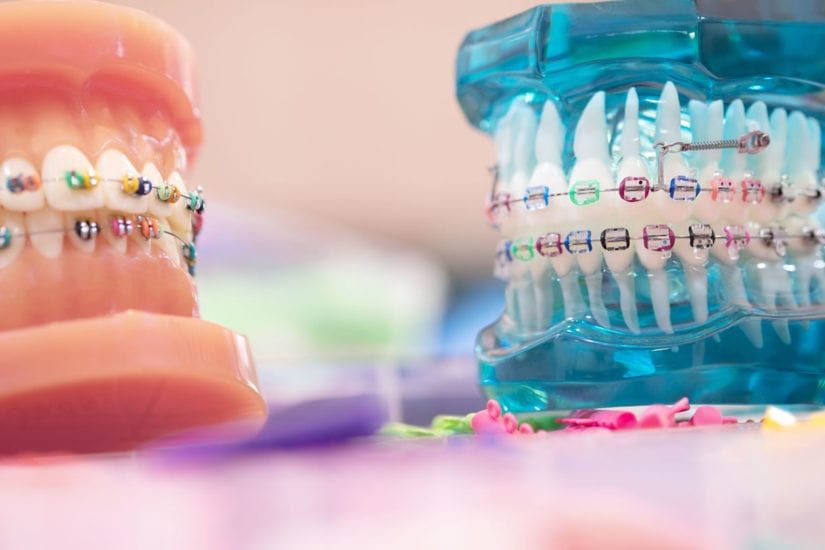 What are the Best Braces Color for You in 2023? - Orthodontic Arts