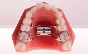 palatal-expander-300x184