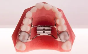 palatal-expander-300x184