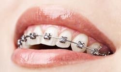 Braces Tulsa OK  Robert J. Herman Orthodontics