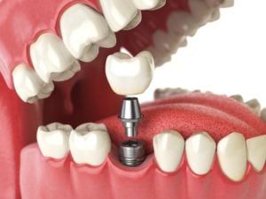 3-d rendered image of a dental implant surrounding by other teeth in the mouth