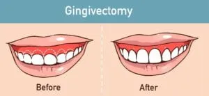 gingivectomy