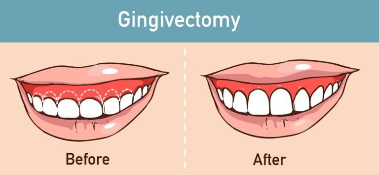 What Is Gum Contouring & Reshaping?, Assembly Dental