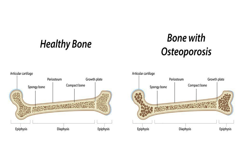 Osteoporosis » Arthritis Care of Texas Advanced Rheumatology