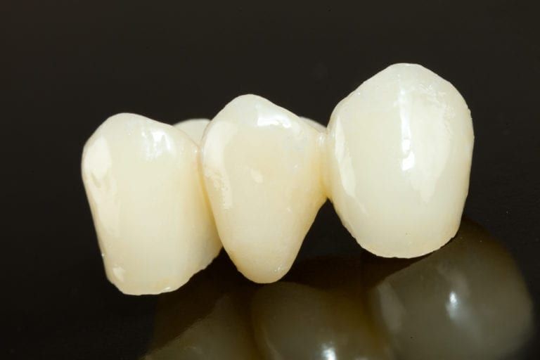 Highly aesthetic emax pressed ceramic bridge / crown