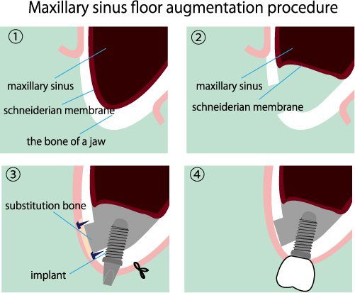 illustration of the process of Maxillary sinus
