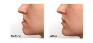 What is Jaw Surgery?, Los Angeles, CA