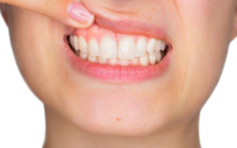 Woman Showing Off Gums
