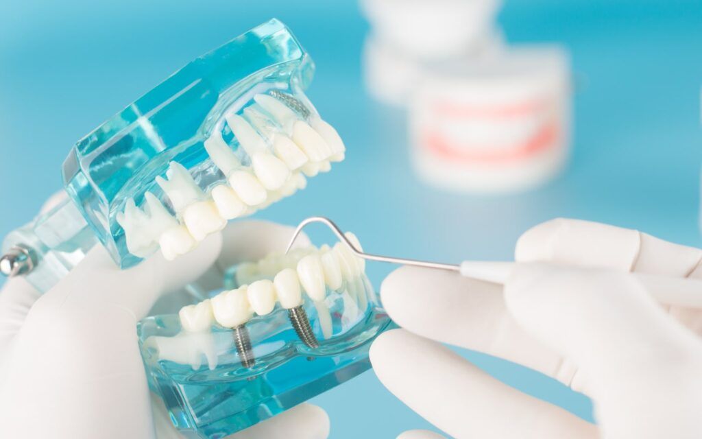 Dental Implants