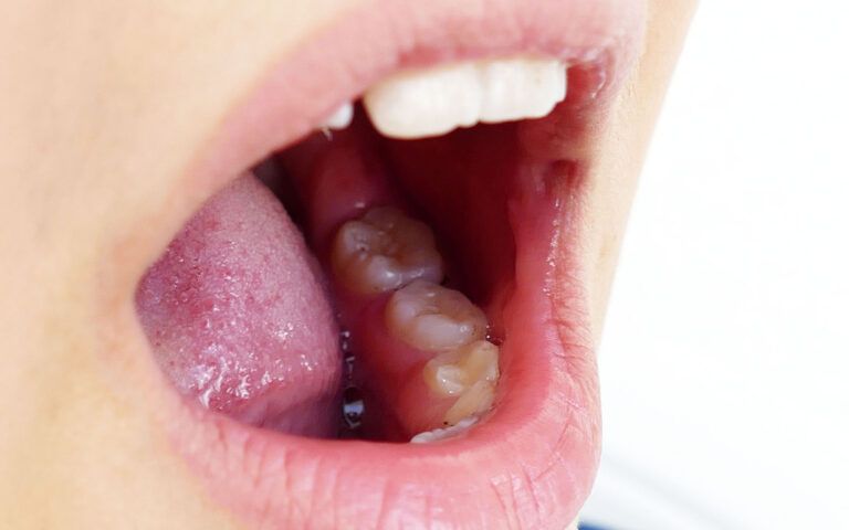 Close Up Photograph of a Person's Mouth Showing Teeth and Gums