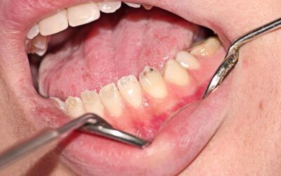 What is Dentinogenesis Imperfecta? 