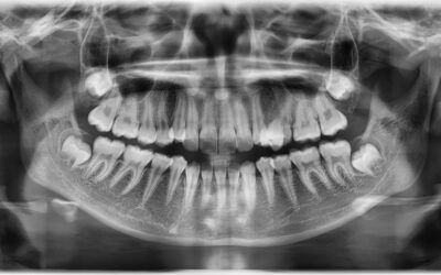 Navigating the Complex World of Impacted Wisdom Teeth