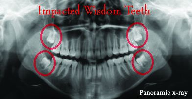 3 Warning Signs of Impacted Wisdom Teeth