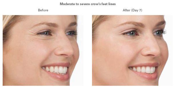 Is Botox, Juvederm or Radiesse right for you?