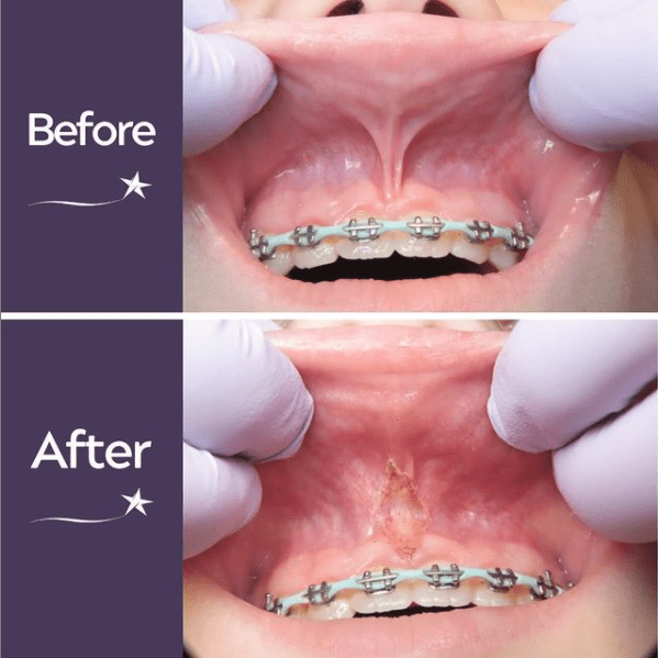 lip and tongue tie, frenectomy