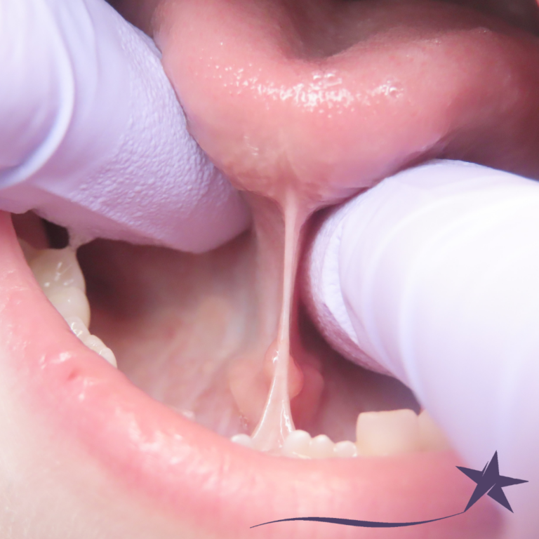 tongue tie, frenectomy, ankyloglossia