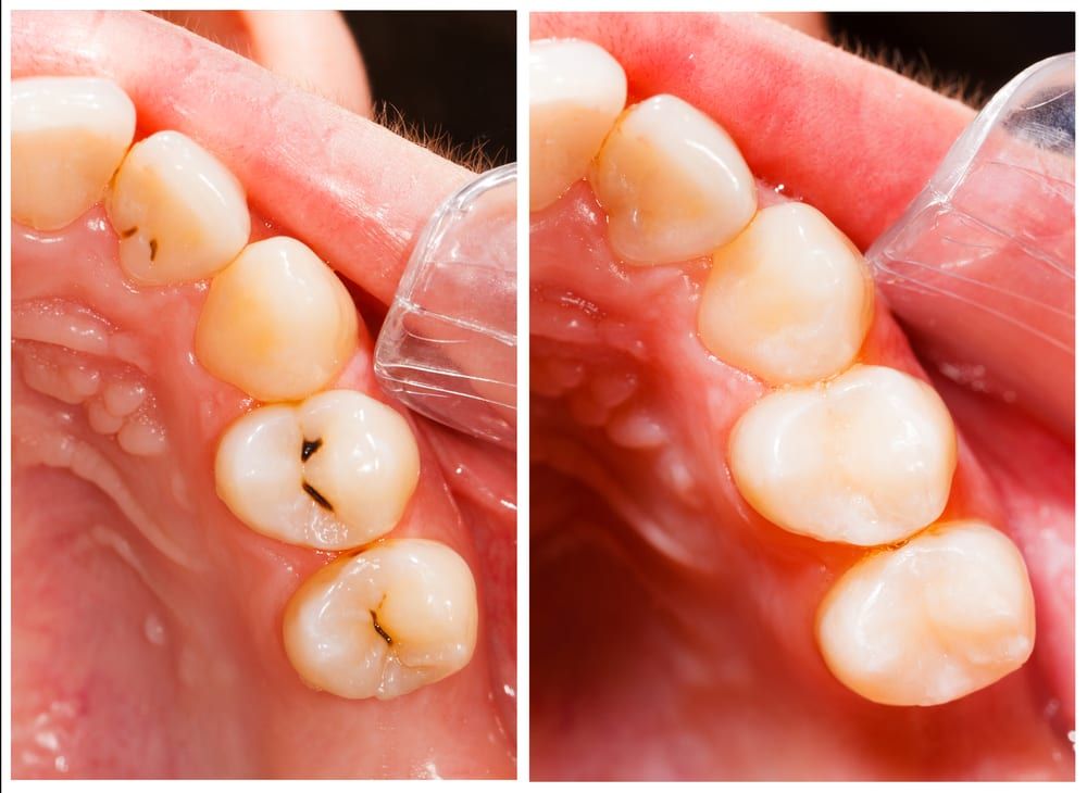 Metal Free Fillings