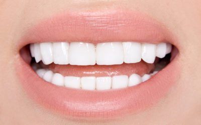 Porcelain Veneers