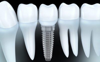 Dental Implants