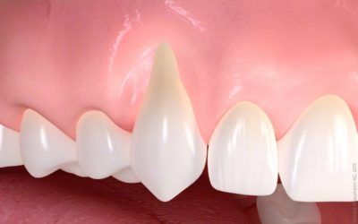 Gum Recession