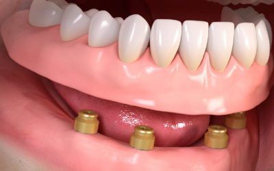 Overdenture