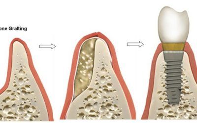 Bone Grafting