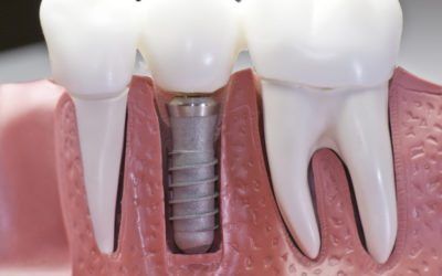 Implants