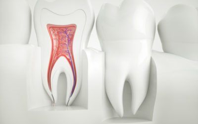 Root Canal
