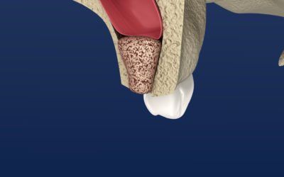 Sinus Lift